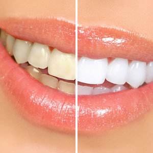 Teeth Whitening in Garden City Before Any Other Cosmetic Dentistry